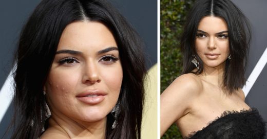 Kendall Jenner envía un mensaje a todas las chicas que sufren de acné como ella