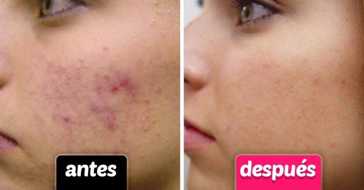 Tipos de cicatrices de acné y cómo tratarlas