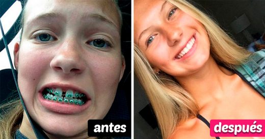 20 Increíbles cambios de dentadura después de usar brackets