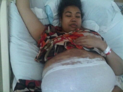 Mujer recostada en la cama con el vientre hinchado por el lupus