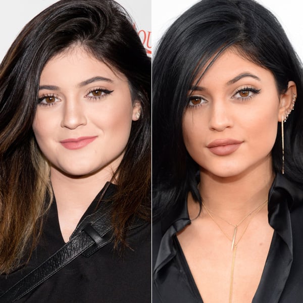 Antes y después de Kylie Jenner con los labios rellenados