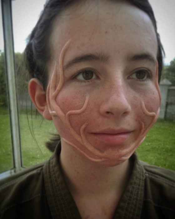 chica con implantes en el rostro