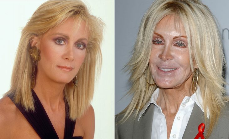 Famosas antes y después de las cirugías plásticas