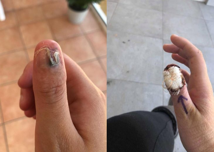A mujer le da cáncer por morderse las uñas
