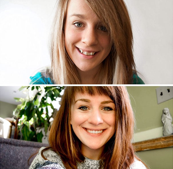 Personas antes y después de usar aparatos dentales 