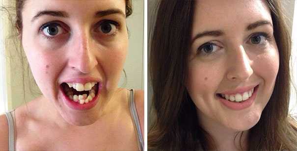 Personas antes y después de usar aparatos dentales 