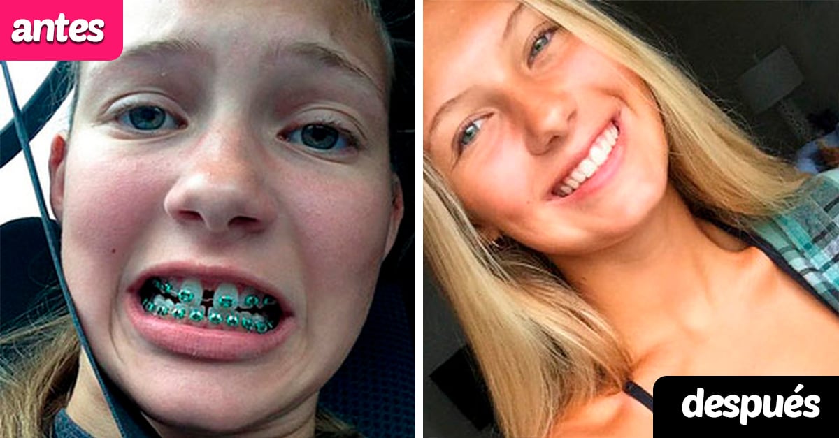 Personas que cambiaron radicalmente luego de usar brackets