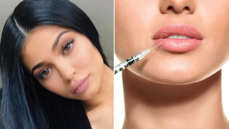 mujer con labios grandes inyecciones de labios 