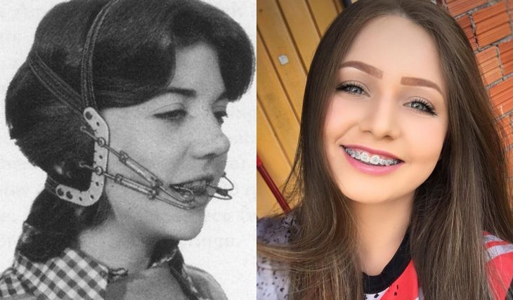 Artículos viejos y nuevos de belleza; aparatos dentales antiguos y modernos, chica con brackets