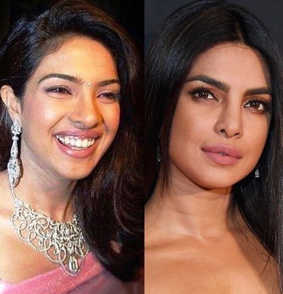 Priyanka Chopra rhinoplasty results