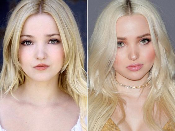 Dove Cameron before and after surgery