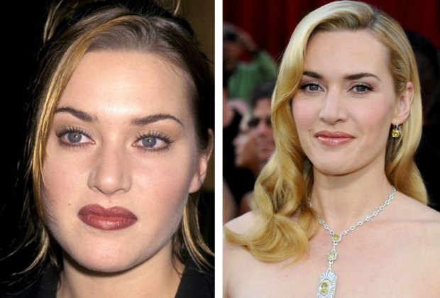 Bichectomy results of Kate winslet Rose