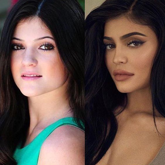 Kylie Jenner antes de las cirugías plásticas / después con los resultados