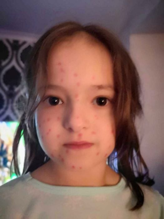 Lily Schooley, niña de seis años se pinta manchas rojas en la cara, piernas y brazos y finge tener varicela para faltar a clases