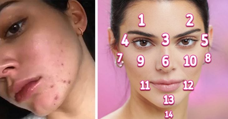 El acné de tu rostro podría revelar una enfermedad severa
