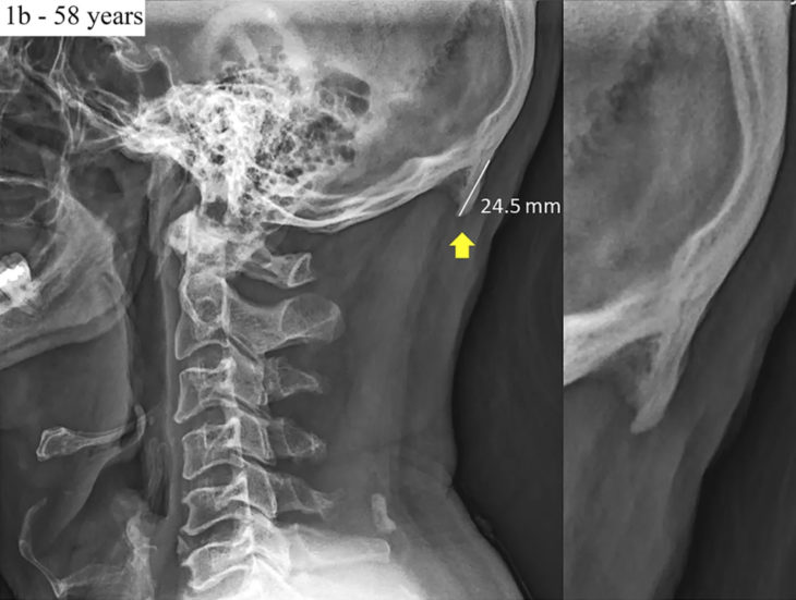 radiografía del crecimiento de espolón detrás de la cabeza