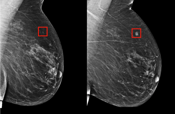 mamografía cáncer de mama inteligencia artificial