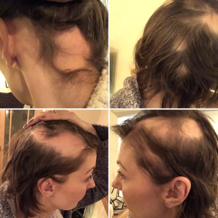 Michelle Wilson Stimson mostrando las partes de su cabello que tienen alopecia