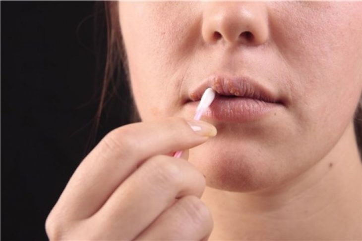 El herpes labial puede quitarle la vida a un bebé