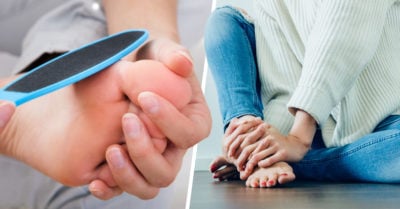 Callos en la planta del pie, las “suelas” de zapato naturales