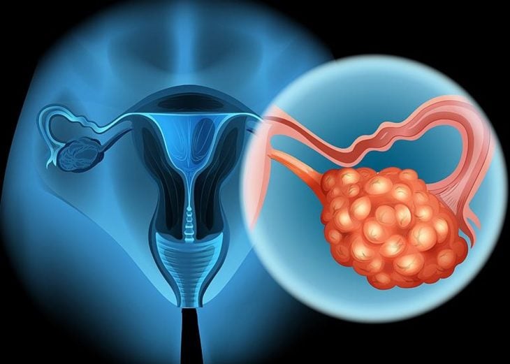 representación gráfica de un cáncer de ovario
