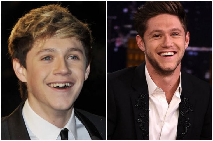 Niall Horan antes y después de arreglar su dentadura