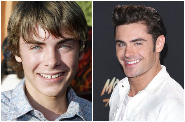 Zac Efron antes y después de arreglar su dentadura