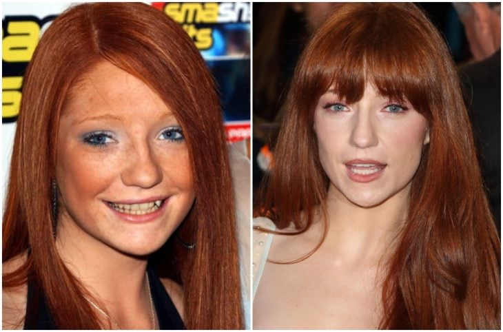 Nicola Roberts antes y después de arreglar su dentadura