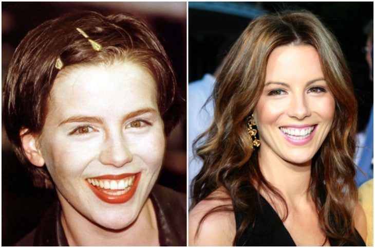 Kate Bickansale antes y después de arreglar su dentadura