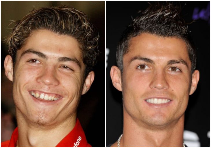 Cristiano Ronaldo antes y después de arreglar su dentadura