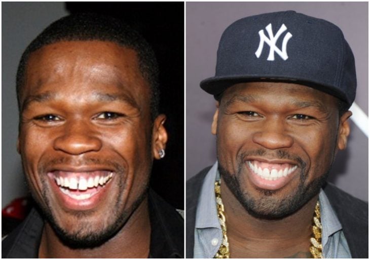 50 Cent antes y después de arreglar su dentadura
