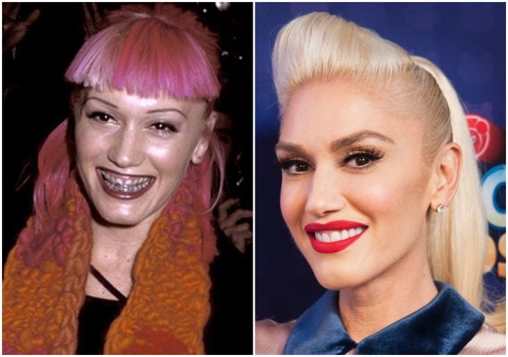 Gwen Stefani antes y después de arreglar su dentadura