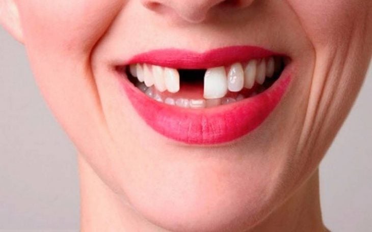 una sonrisa de una mujer con los labios pintados sin un diente frontal