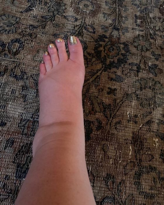 Foto de un pie muy inflamado
