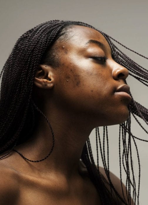 Mujer afroamericana con acné