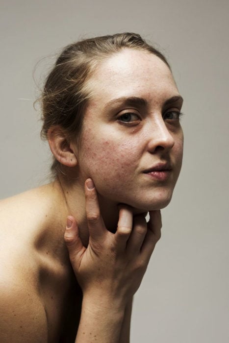 Retrato mujer con acné