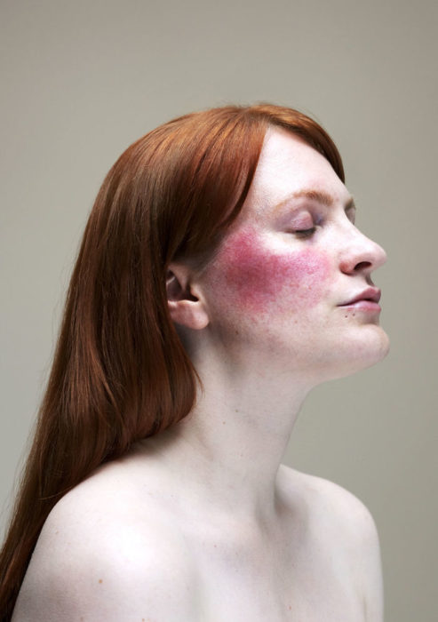 Retrato de mujer con rosácea