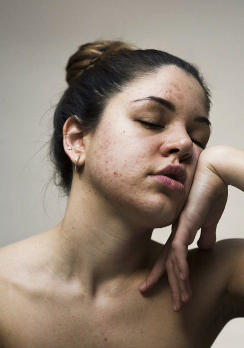 Retrato de mujer con piel irritada y granitos