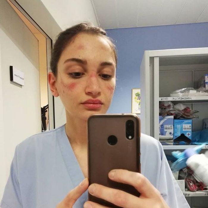 Mujer médico tomando una selfie de su rostro marcado por el uso de mascarillas especiales