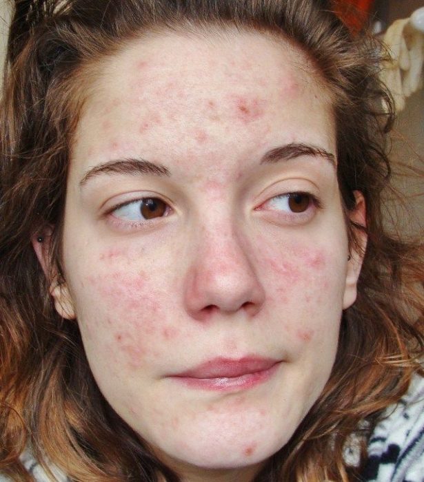 Chica que padece dermatitis