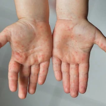 Manos de un niño llenas con puntos rojos