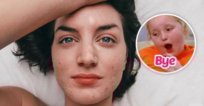 12 Tips para disminuir el acné durante tu periodo