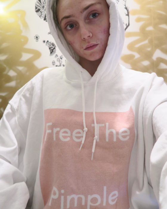 Free the Pimple hoodie