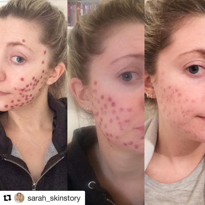Proceso de mejora del acné en el rostro de una chica