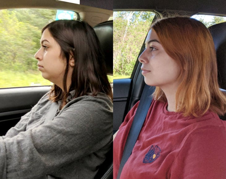 Mujer de perfil antes y después de bajar de peso