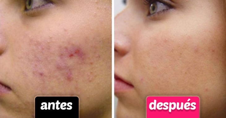 Chica de perfil mostrando el antes y después de usar agua de rosas como tratamiento anti acné 