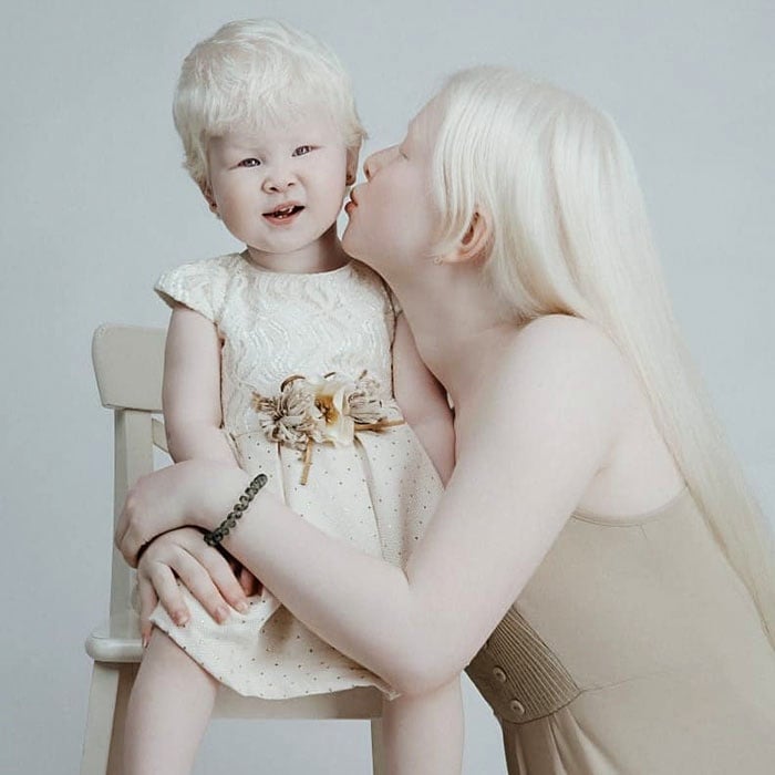 asel y kamila dos hermanas de kazajistán con albinismo