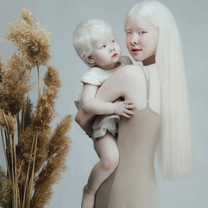 kamila y asel son dos niñas con albinsmo de kazajistán