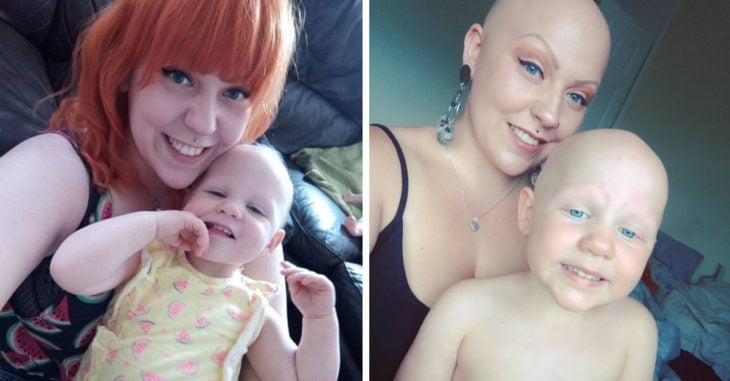 Madre e hija padecen alopecia; no les importan los estereotipos