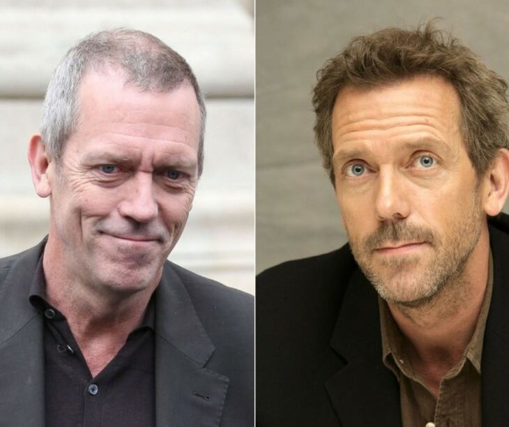 Hugh Laurie antes y después del injerto de cabello